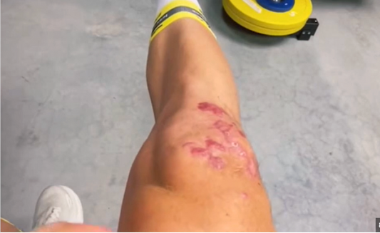 Le rôle du bikefitting dans la rééducation après blessure au genou