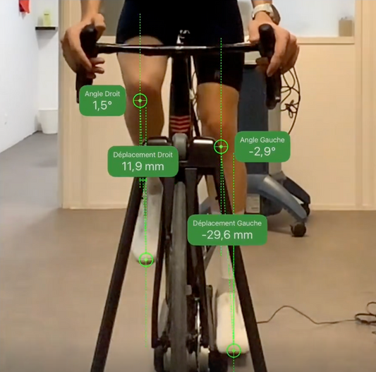 Le valgus du genou : correction ou non ?