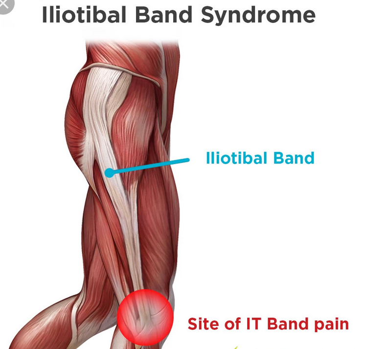 Syndrome de la bandelette ilio-tibiale en cyclisme